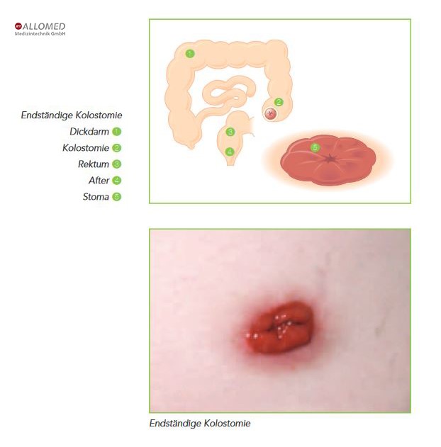 Grundinformationen zum Thema Stoma Operation Produktinformationen