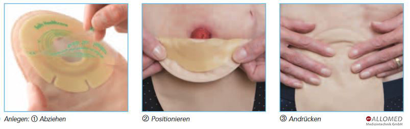 Stoma Wechsel