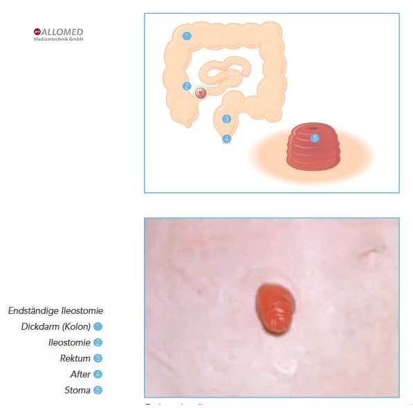 Grundinformationen zum Thema Stoma Operation - Produktinformationen